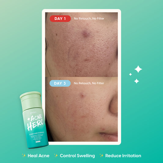 Gorjes Acne Hero Toner & Essence | 100 ml