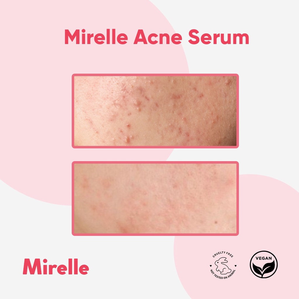 MIRELLE Acne Serum 15ml