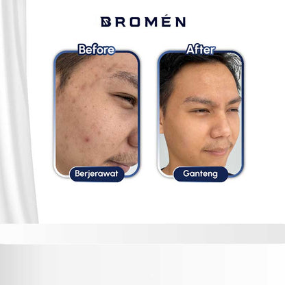 BROMEN Acne Fight Expert Facial Wash 100ml