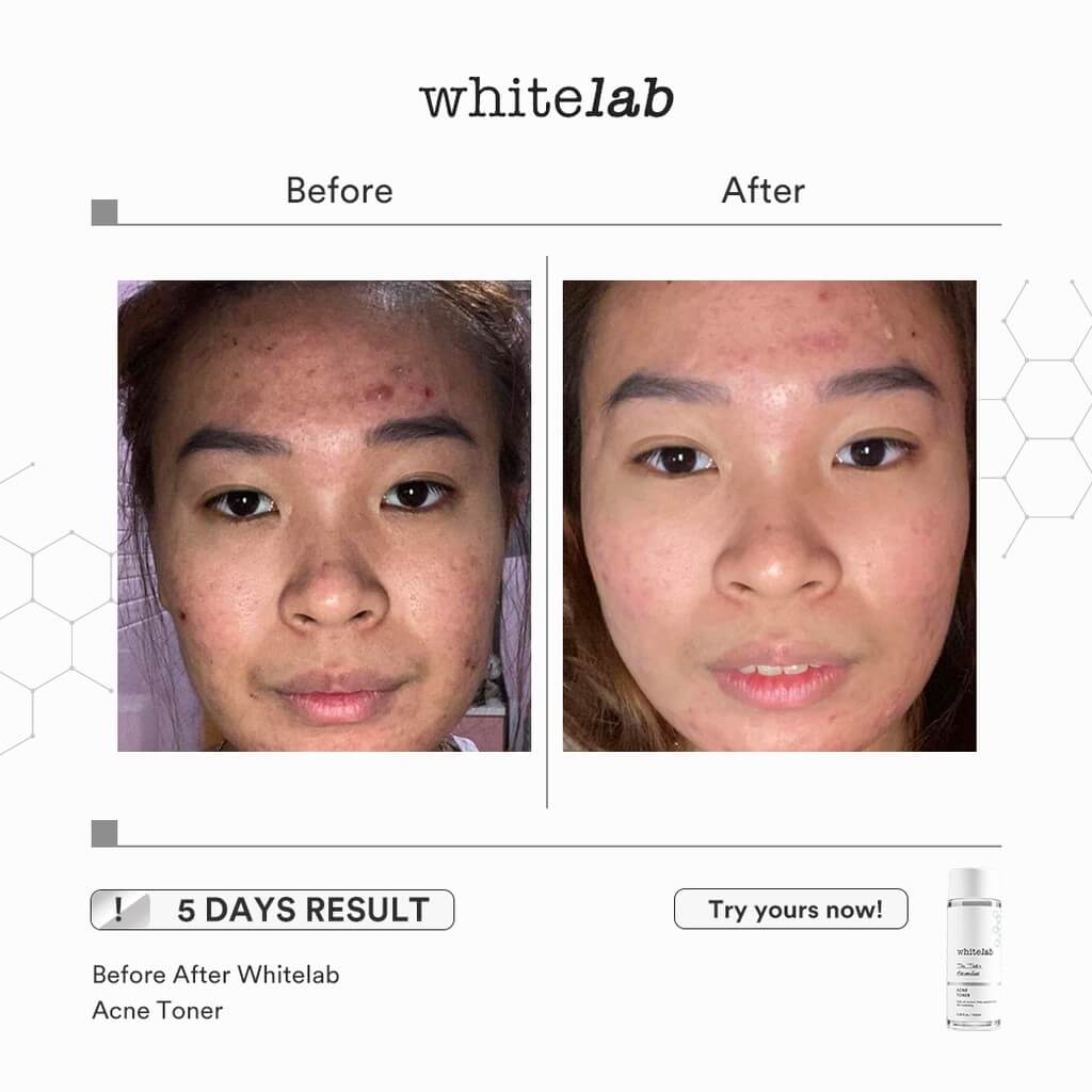 Whitelab Acne Toner